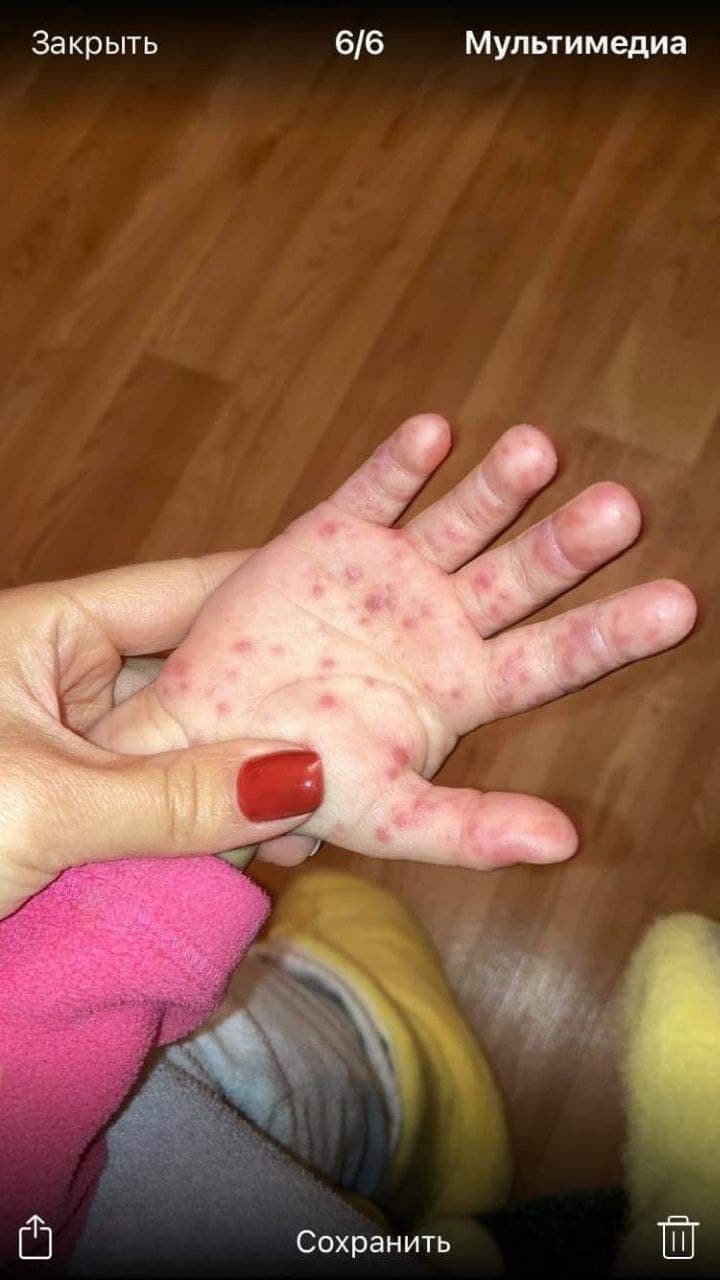 У полтавських дитсадочках діти хворіють вірусом Коксакі: що кажуть лікарі