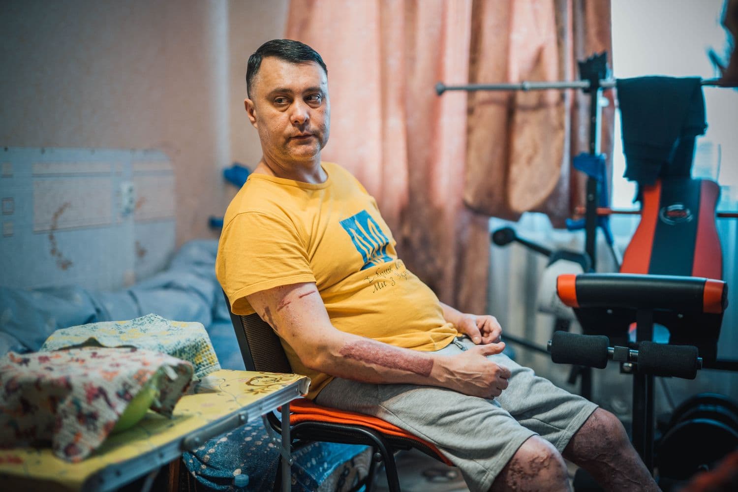 Маріуполець з опіками від фосфорних бомб потребує допомоги полтавців