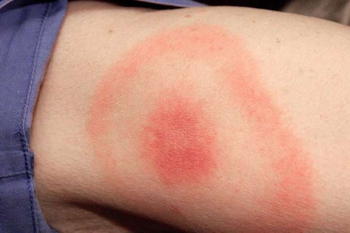 На Полтавщині за тиждень зафіксували 23 випадки хвороби Лайма