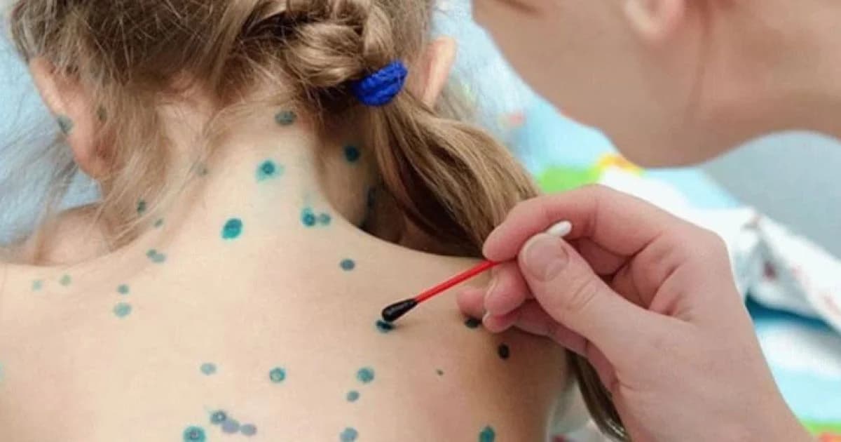 Понад сто полтавців захворіли на вітрянку наприкінці травня